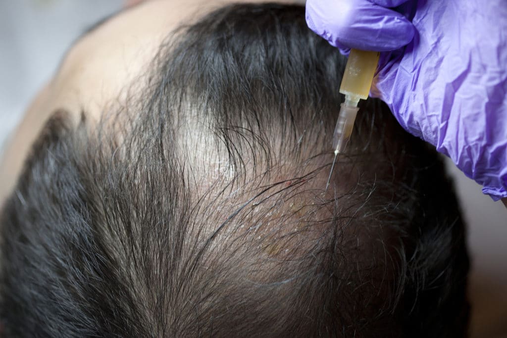 PRP HAIR TREATMENT