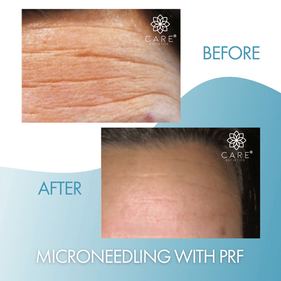 microneedling-prf-img.png