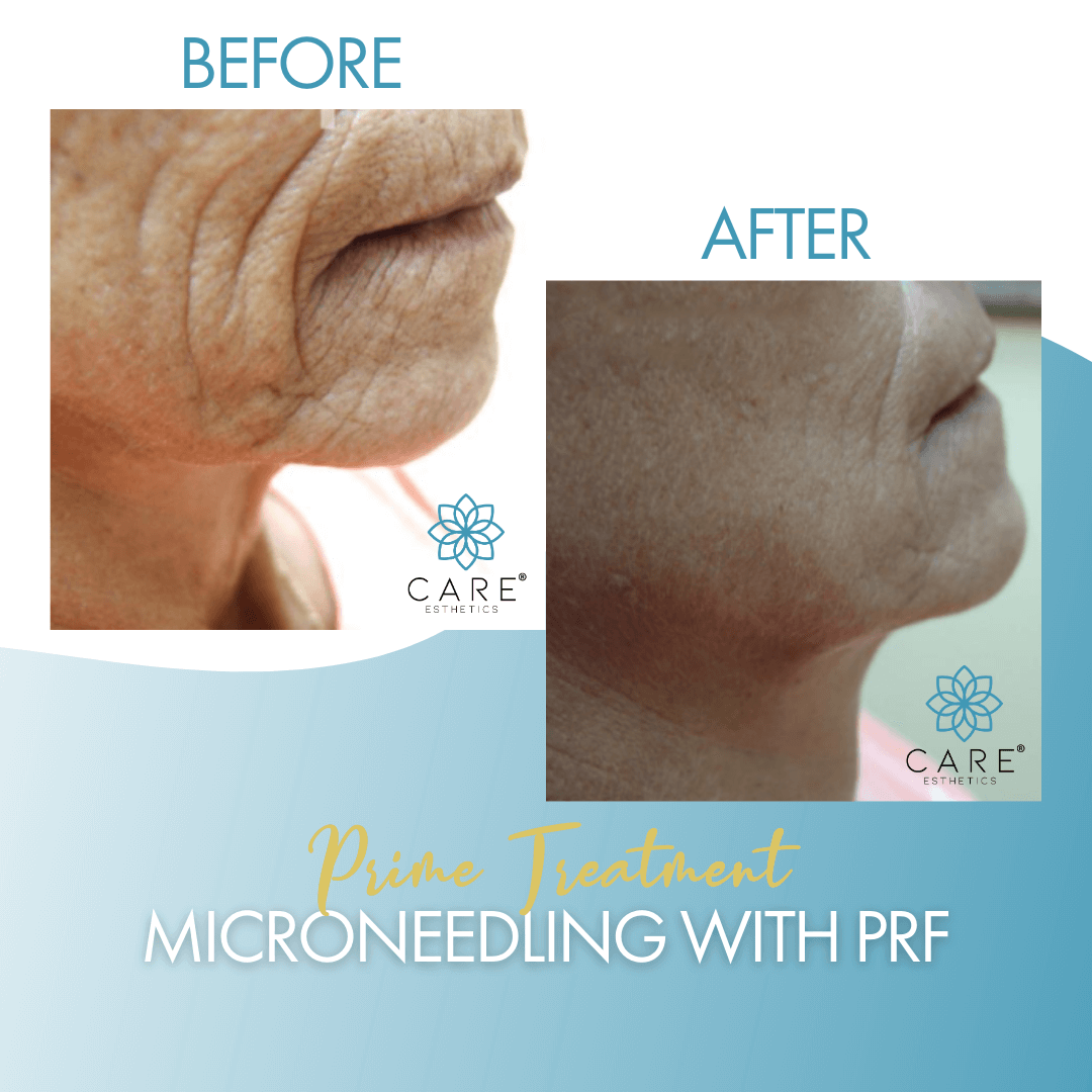 prime-microneedling-prf-img.png