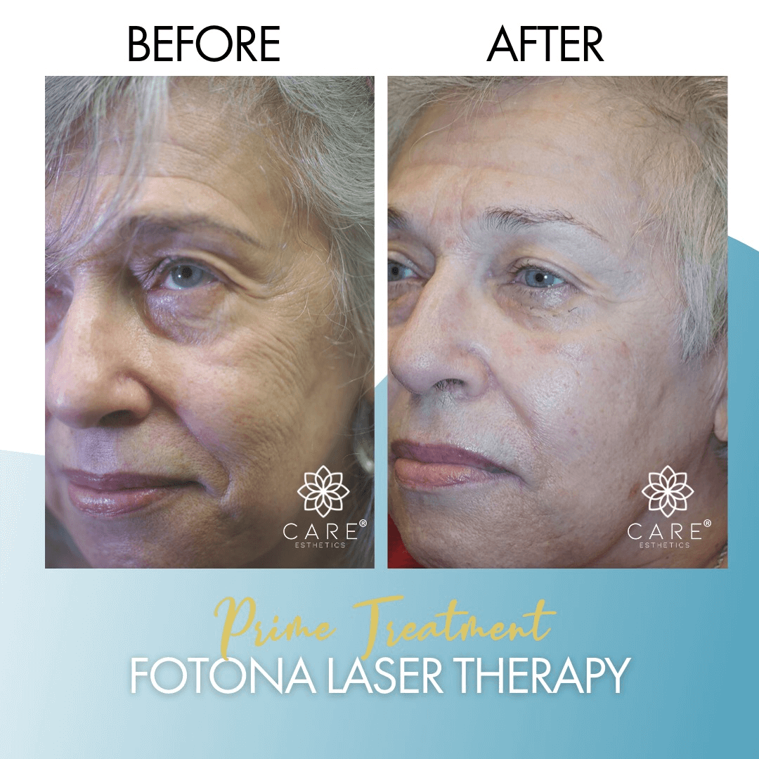 prime-treatment-laser-fotona-2.png