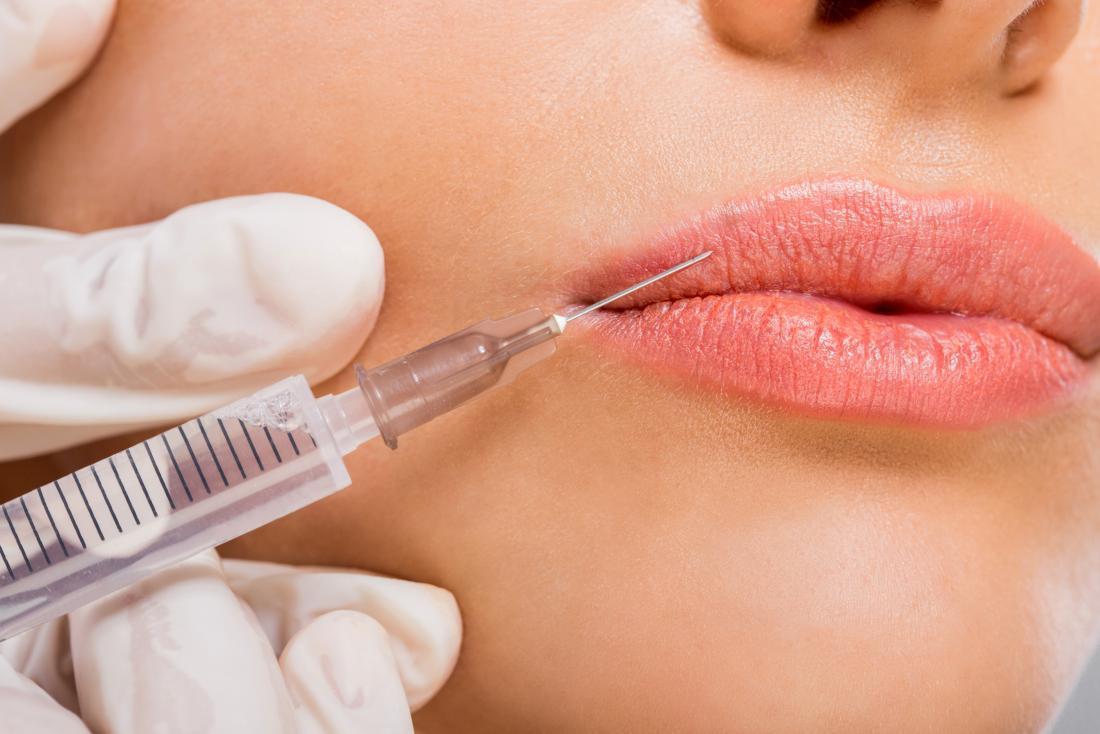 dermal-fillers