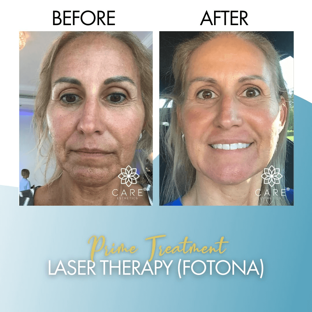 prime-treatment-laser-fotona